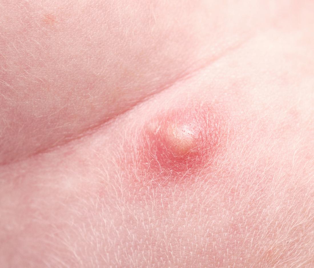 Pimple on scrotum: Causes, types, and when to see a doctor